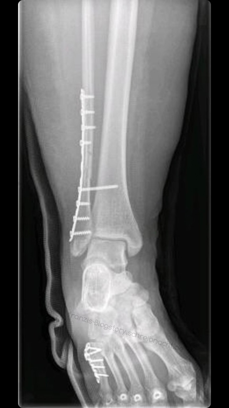 Das Sprunggelenk Anatomie und Chirurgie OTA Franzi